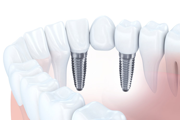 インプラント治療画像